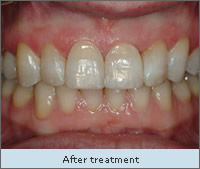 Before Treatment