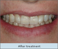 After Treatment