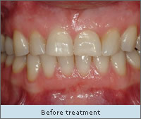 Before treatment