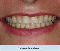 After Treatment