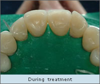 During Treatment