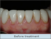 Before treatment