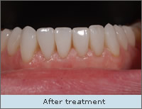 After treatment