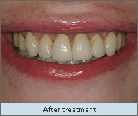 After Treatment