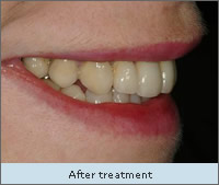 After Treatment