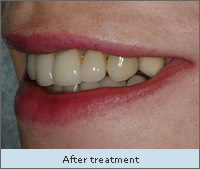 After Treatment