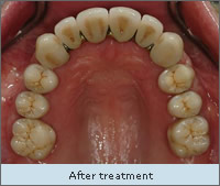After treatment