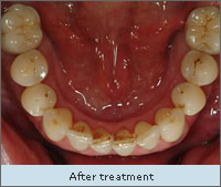After treatment