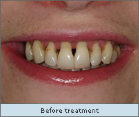 Before treatment