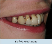 Before Treatment
