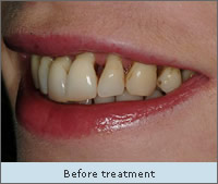 Before Treatment