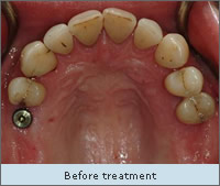 Before treatment