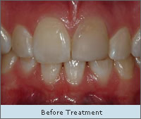 Before treatment