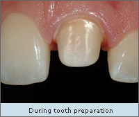 During tooth preparation