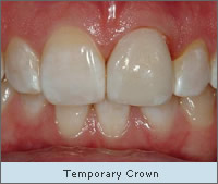 Temporary crown