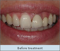 Before treatment