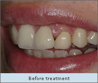 Before treatment