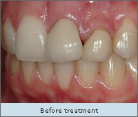 Before treatment