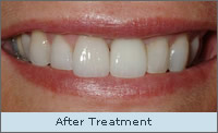 After Treatment