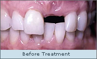 Before Treatment