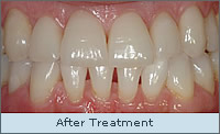 After treatment