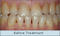 Before treatment