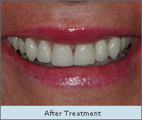 After Treatment
