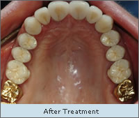 After Treatment