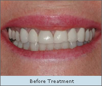 Before Treatment 