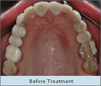 Before Treatment
