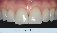 After treatment