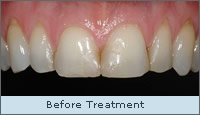 Before treatment