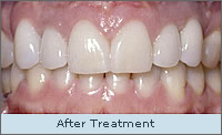 After treatment - with crowns veneers and implants