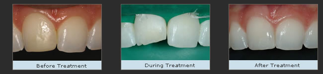 Before and after composite bonding
