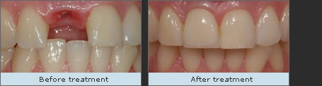 Before and after treatment with dental implants