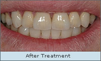 After Treatment