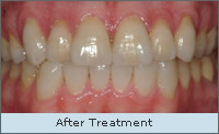 After Treatment