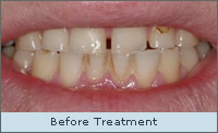Before treatment