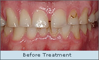 Before treatment