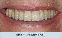 After Treatment