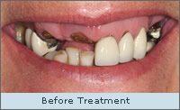 Before Treatment