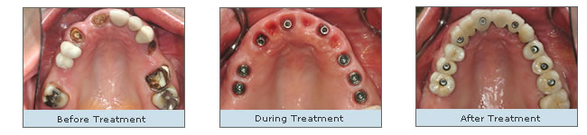 Use of dental implants to replace many teeth - before during and after treatment