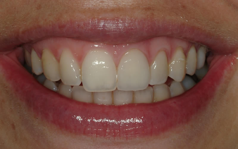 Crowns Case 2 - After Treatment