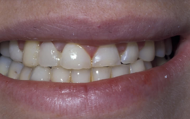 Crowns Case 3 - Before Treatment
