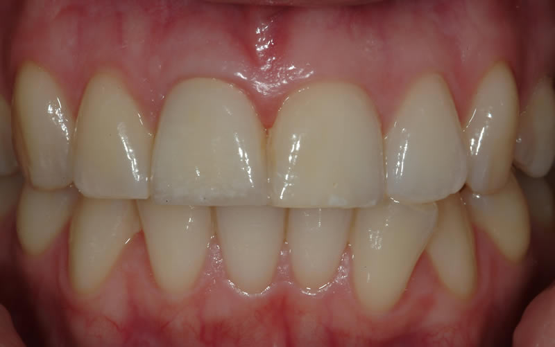 Dental Implant Case 3  - After Treatment
