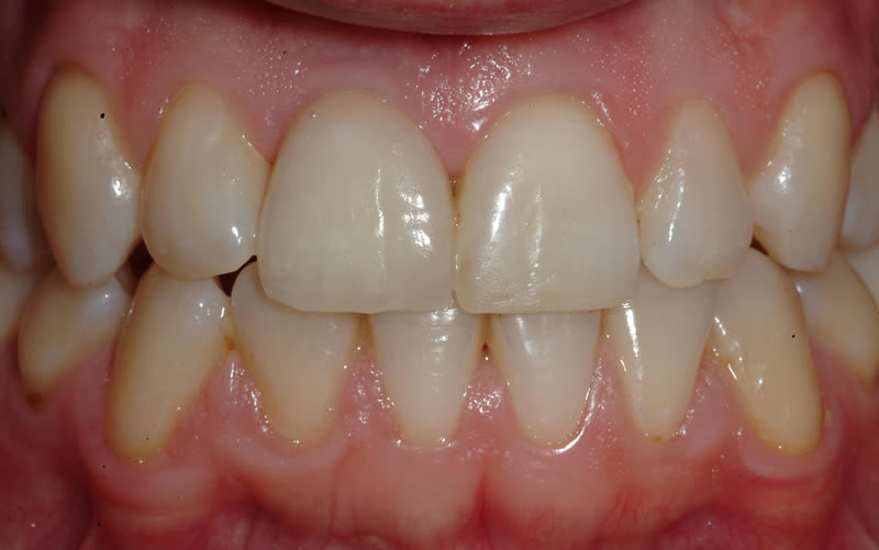 Dental Implant Case 4  - After Treatment