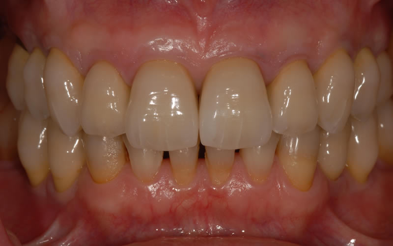 Full Mouth Rehabilitation - Case 1 - After Treatment