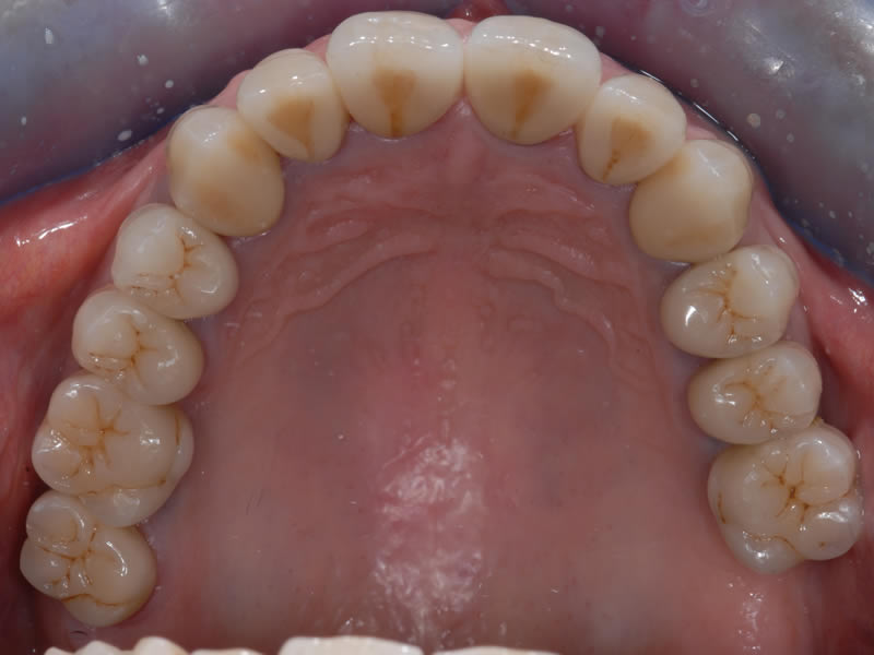 Full Mouth Rehabilitation - Case 1 - After Treatment