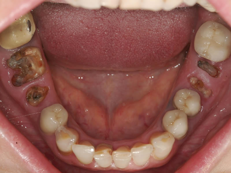 Full Mouth Rehabilitation - Case 1 - Before Treatment