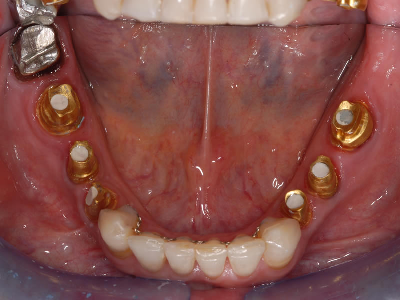 Full Mouth Rehabilitation - Case 1 - Before Treatment